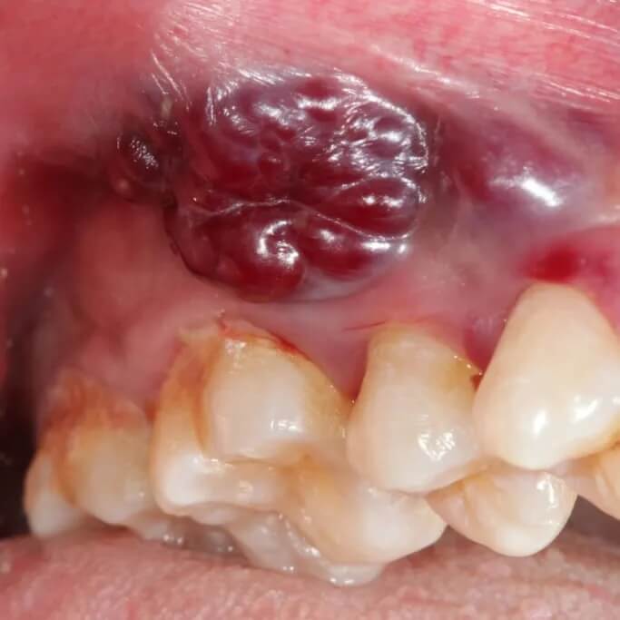 Oral Cancer