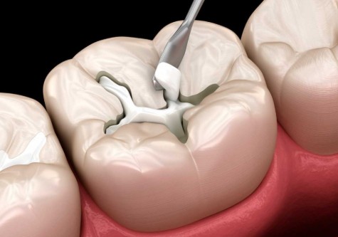 dental filling