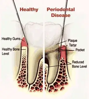 Gum disease