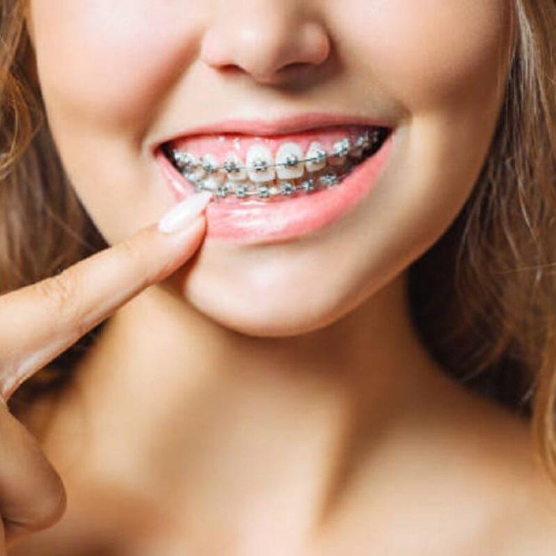 fast braces