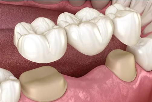 dental bridge