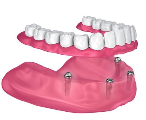 teethxpress