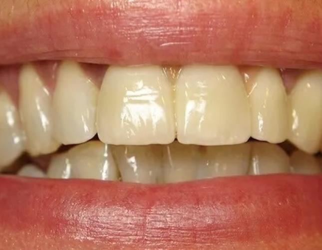 Anterior crowns after