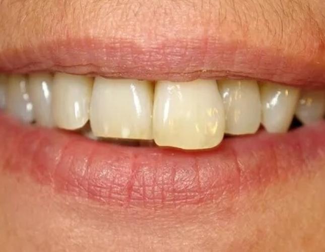 Anterior crowns before