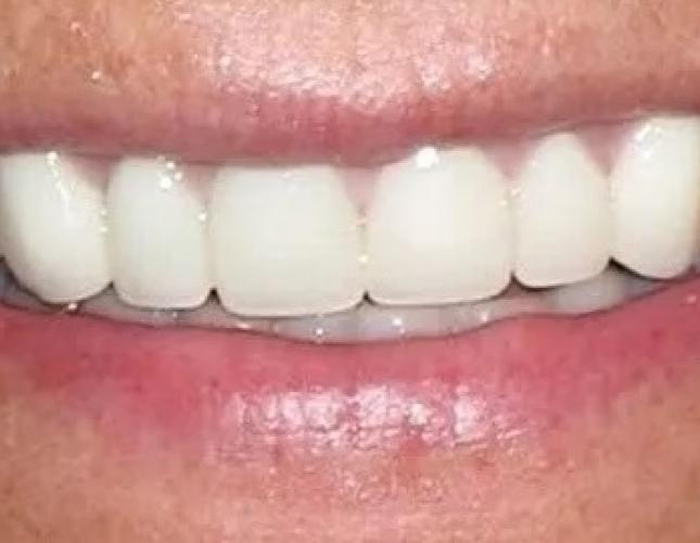 Crowns after