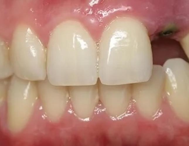 Implant crown before