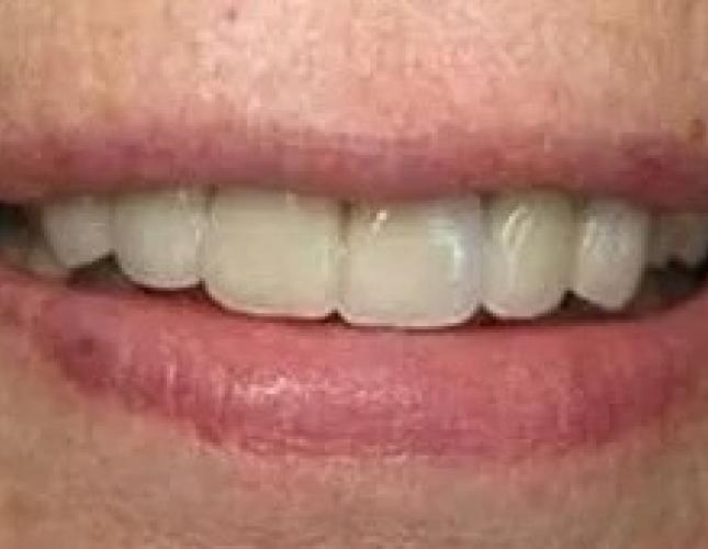 Implant Placement after