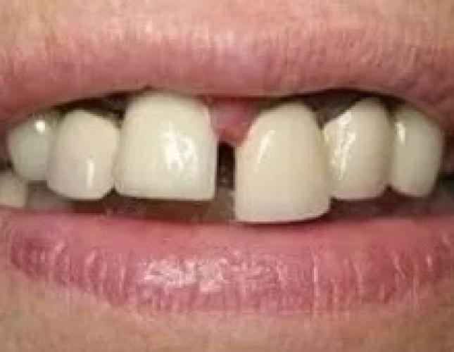 Implant Placement before