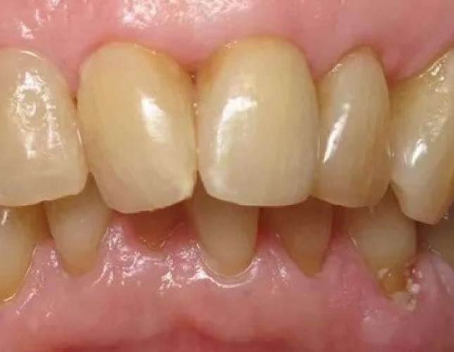 Porcelain Crown3 after