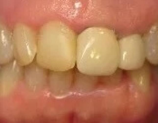 Porcelain Crown before
