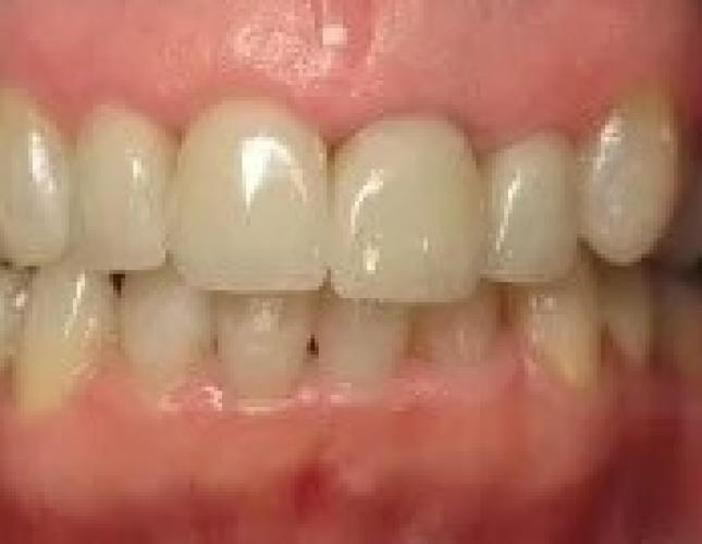 Porcelain Crown after