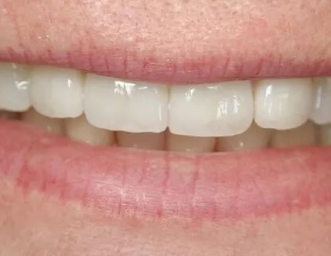 Porcelain Crowns2 after