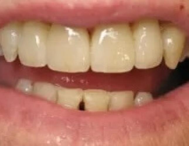 porcelain crowns after