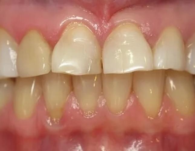 Porcelain Crowns2 before