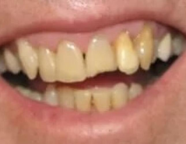 porcelain crowns before