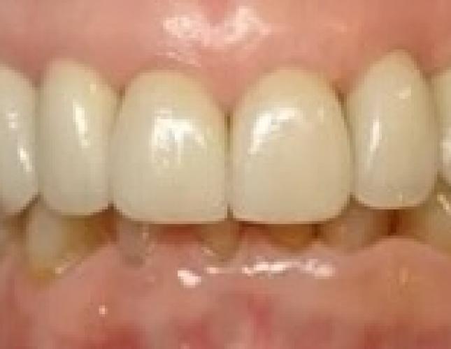 Veneers whitening after