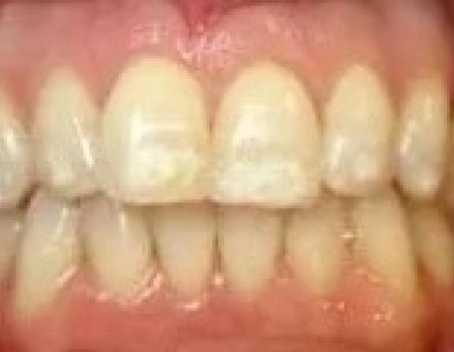 Veneers whitening before