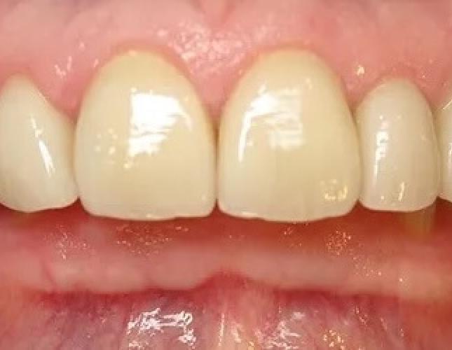 whitening veneers after
