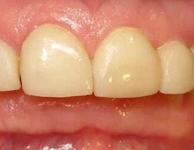 whitening veneers before