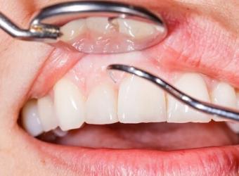 Periodontal Disease: The Connection between the Mouth and Body