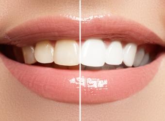 Teeth Whitening Tips By Syracuse Dentist